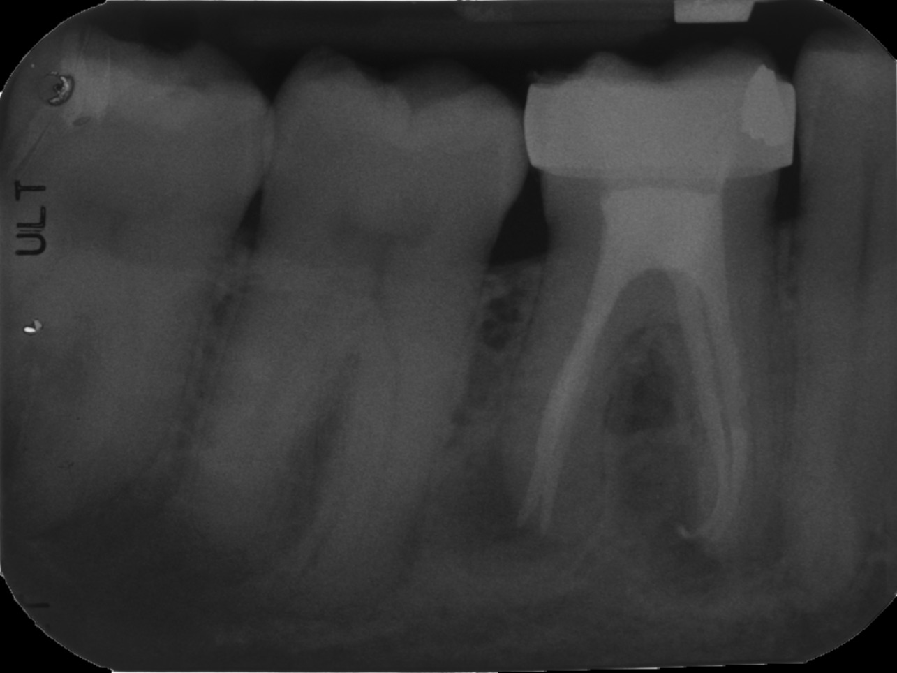 Hobart Endodontics, root canal retreatment