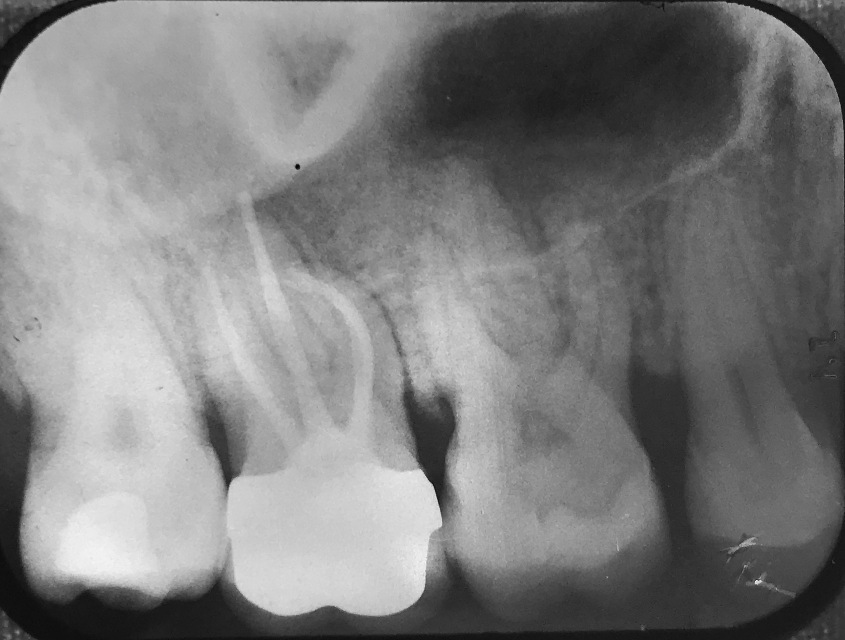 Hobart Endodontics, root canal retreatment